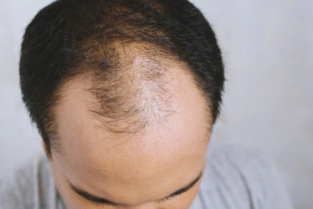 how to avoid male pattern baldness