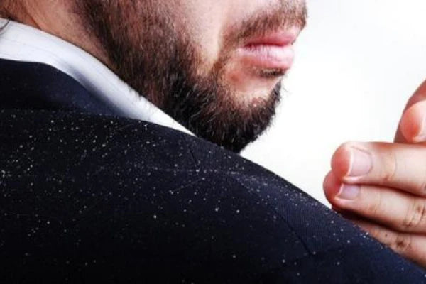 dandruff on man's shoulder | is dandruff contagious