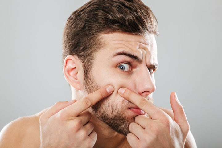 Quick Remedies for Adult Acne in Men