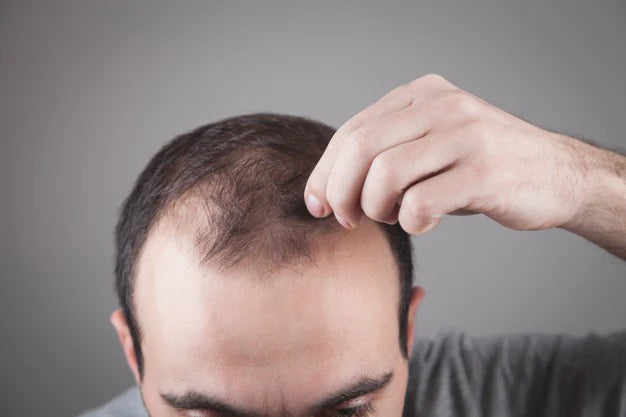 Products for Hair Fall | Top Anti-Hair Fall Products for Hair Loss | bald man 