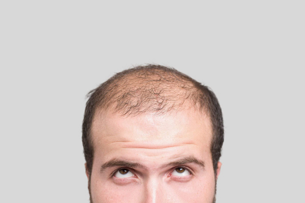 Male Pattern Baldness