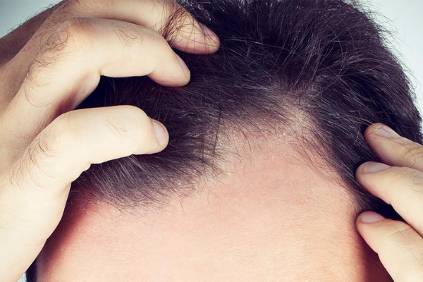 Male Pattern Baldness