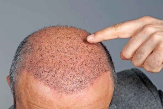 Hair transplant