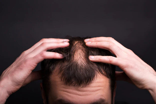 Male pattern baldness | What are visible signs of balding at 20?