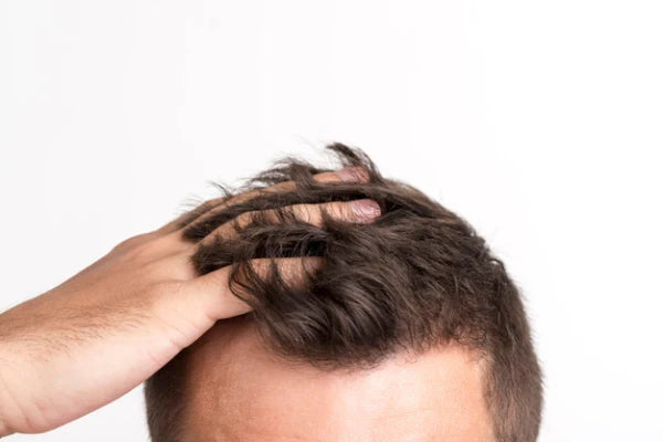 hair loss on templates