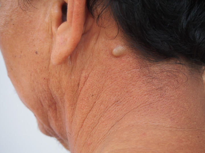 Treatments for sebaceous cyst