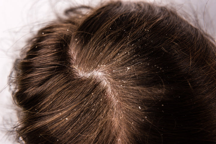 Scalp Psoriasis and Dandruff