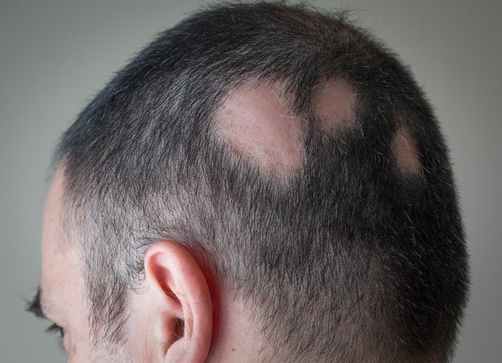 Patchy hair loss