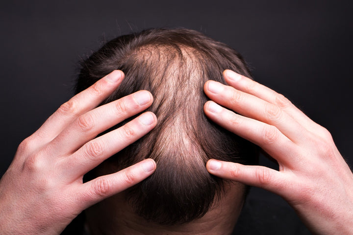 Foods that cause hair fall in men