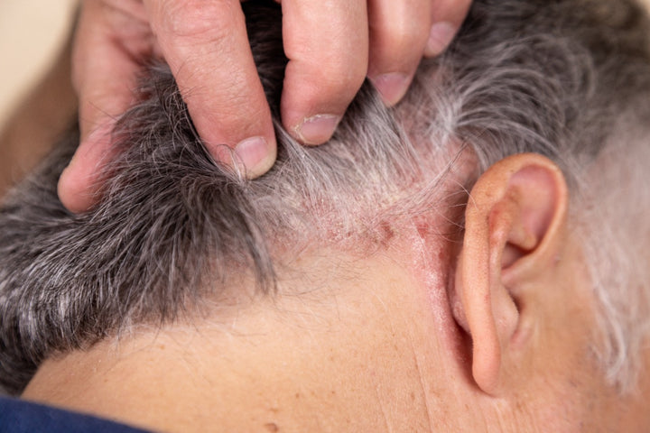 Scalp Psoriasis