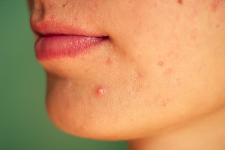 Nodular Acne