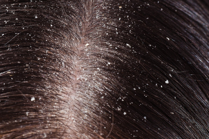 Dandruff problem