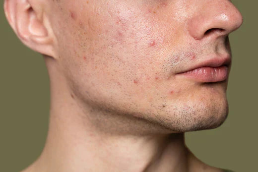Salicylic Acid Gel 