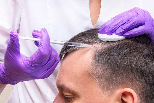 PRP for hair loss treatment 